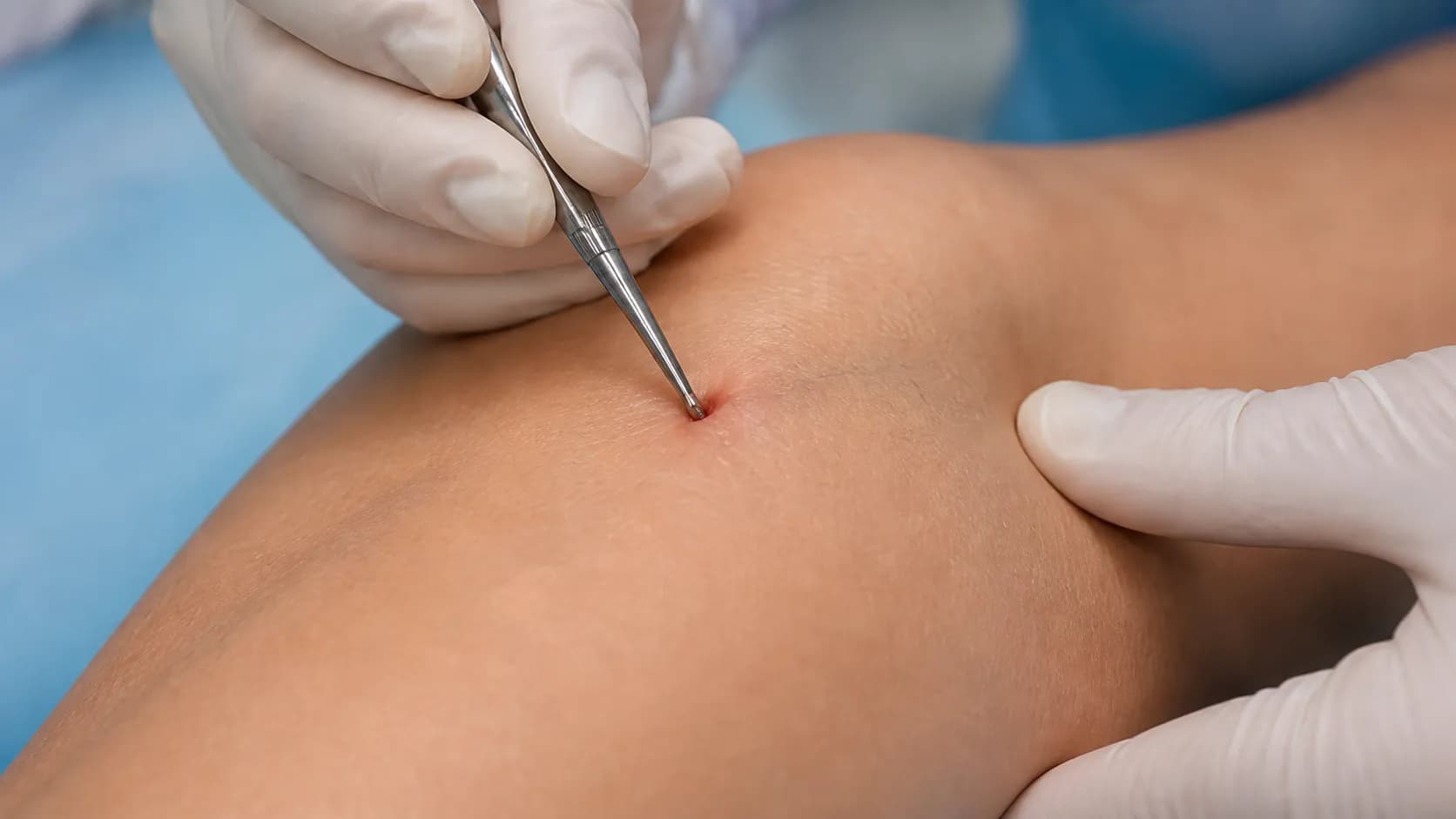 Минифлебэктомия — удаление варикозных вен через микропроколы в Avenia Clinic, Алматы