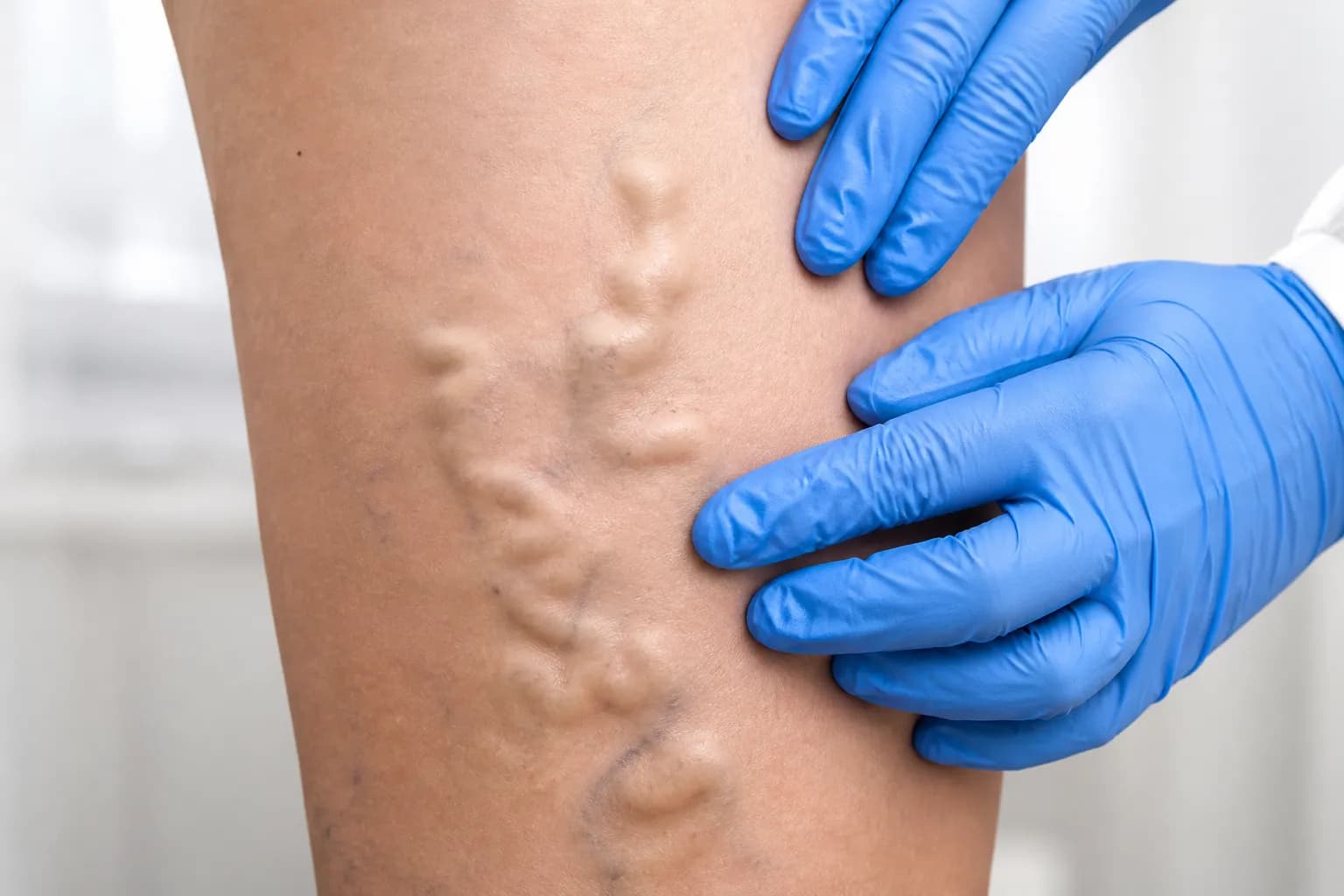 Признаки варикоза и состояние венозной системы — консультация в Avenia Clinic